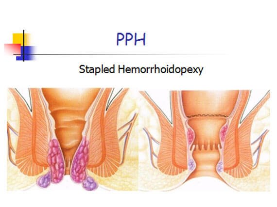 thrombosed hemorrhoid excision